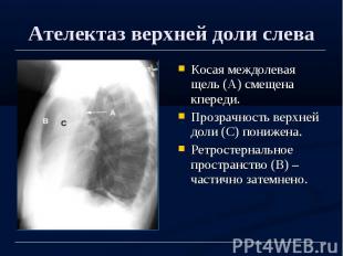 Ателектаз верхней доли слева Косая междолевая щель (А) смещена кпереди. Прозрачн