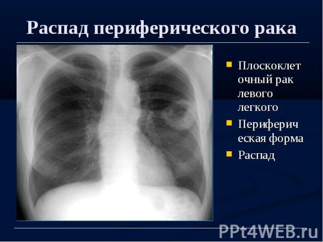 Распад периферического рака Плоскоклеточный рак левого легкого Периферическая форма Распад