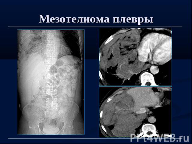 Мезотелиома плевры