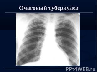 Очаговый туберкулез
