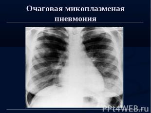 Очаговая микоплазменая пневмония