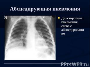 Абсцедирующая пневмония Двусторонняя пневмония, слева с абсцедированием