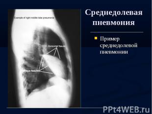 Среднедолевая пневмония Пример среднедолевой пневмонии