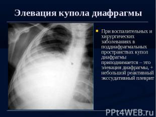 Элевация купола диафрагмы При воспалительных и хирургических заболеваниях в подд