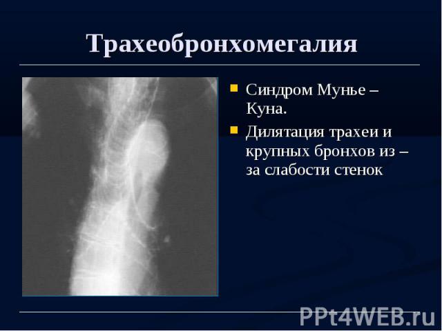 Трахеобронхомегалия Синдром Мунье – Куна. Дилятация трахеи и крупных бронхов из – за слабости стенок