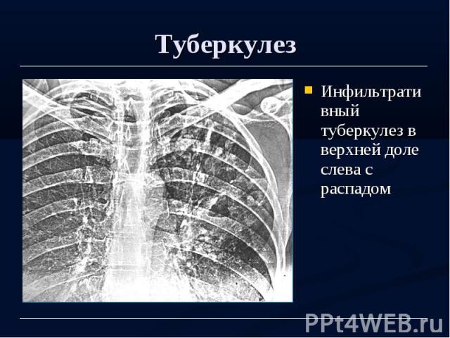 Туберкулез Инфильтративный туберкулез в верхней доле слева с распадом