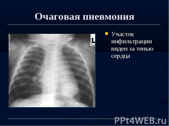 Очаговая пневмония Участок инфильтрации виден за тенью сердца