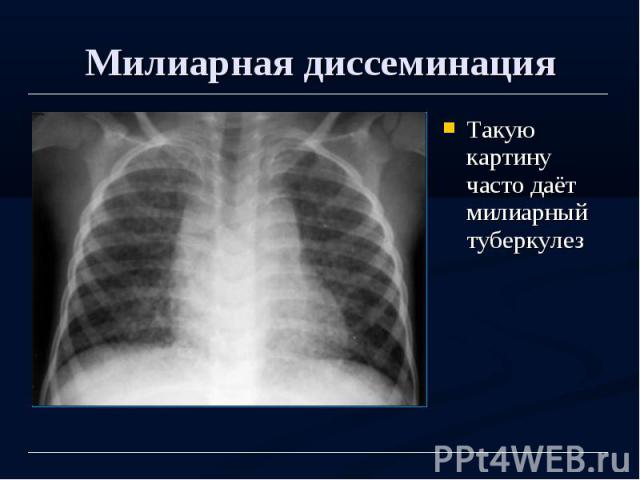 Милиарная диссеминация Такую картину часто даёт милиарный туберкулез