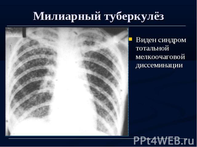 Милиарный туберкулёз Виден синдром тотальной мелкоочаговой диссеминации