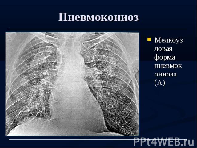 Пневмокониоз Мелкоузловая форма пневмокониоза (А)