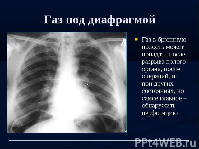 Газ под диафрагмой Газ в брюшную полость может попадать после разрыва полого органа, после операций, и при других состояниях, но самое главное – обнаружить перфорацию