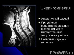Сирингомиелия Аналогичный случай При данном варианте поражения в спинном мозге м