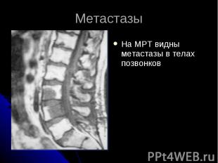 Метастазы На МРТ видны метастазы в телах позвонков
