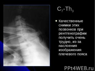 С7-Th3 Качественные снимки этих позвонков при рентгенографии получить очень труд