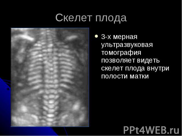 Скелет плода 3-х мерная ультразвуковая томография позволяет видеть скелет плода внутри полости матки