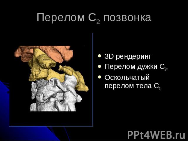 Перелом С2 позвонка 3D рендеринг Перелом дужки С2, Оскольчатый перелом тела С3