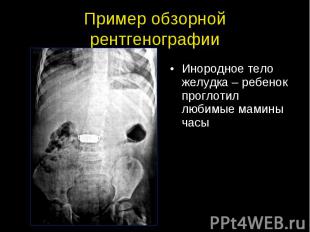 Пример обзорной рентгенографии Инородное тело желудка – ребенок проглотил любимы