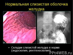 Нормальная слизистая оболочка желудка Складки слизистой желудка в норме (эндоско