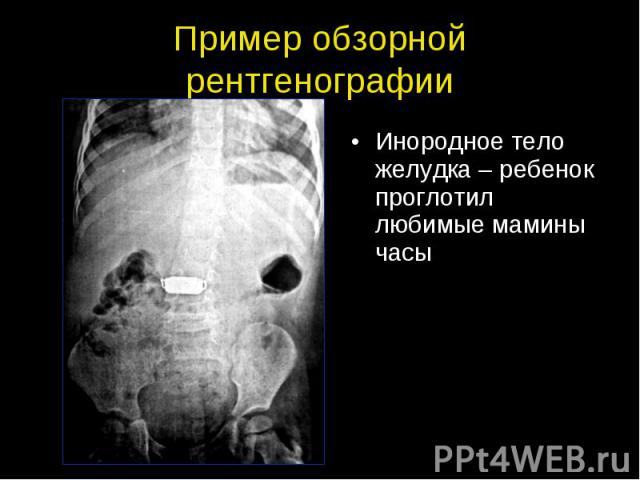 Пример обзорной рентгенографии Инородное тело желудка – ребенок проглотил любимые мамины часы