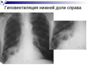 Гиповентиляция нижней доли справа