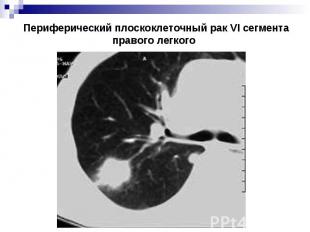 Периферический плоскоклеточный рак VI сегмента правого легкого