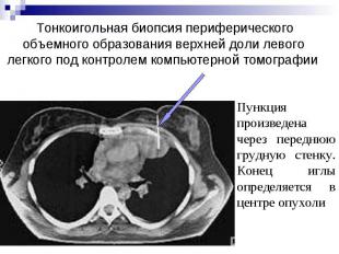 Тонкоигольная биопсия периферического объемного образования верхней доли левого