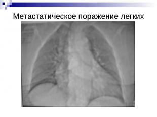 Метастатическое поражение легких