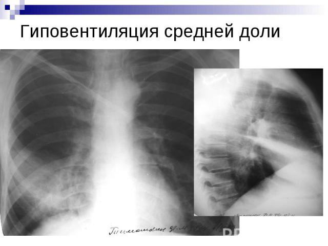 Гиповентиляция средней доли