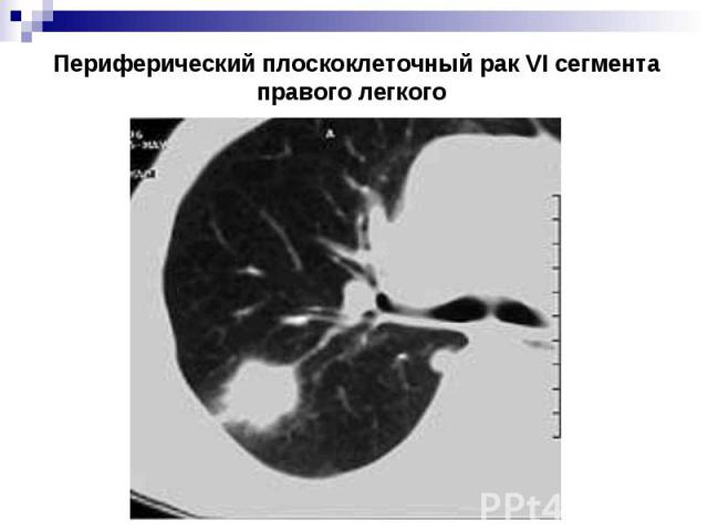 Периферический плоскоклеточный рак VI сегмента правого легкого