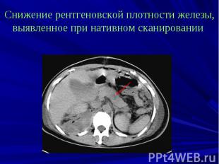 Снижение рентгеновской плотности железы, выявленное при нативном сканировании