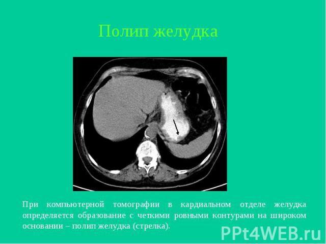 При компьютерной томографии в кардиальном отделе желудка определяется образование с четкими ровными контурами на широком основании – полип желудка (стрелка).