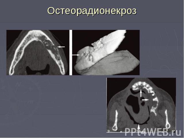 Остеорадионекроз