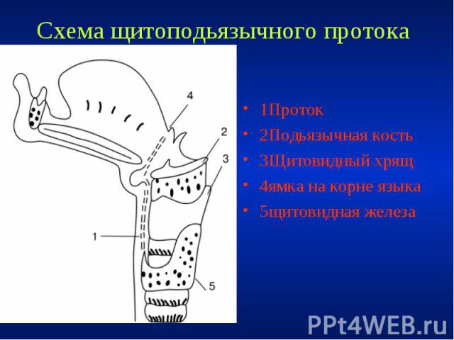 Схема щитоподьязычного протока 1Проток 2Подьязычная кость 3Щитовидный хрящ 4ямка на корне языка 5щитовидная железа