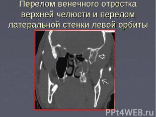 Перелом венечного отростка верхней челюсти и перелом латеральной стенки левой ор