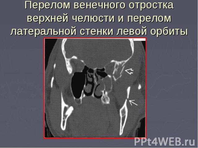 Перелом венечного отростка верхней челюсти и перелом латеральной стенки левой орбиты