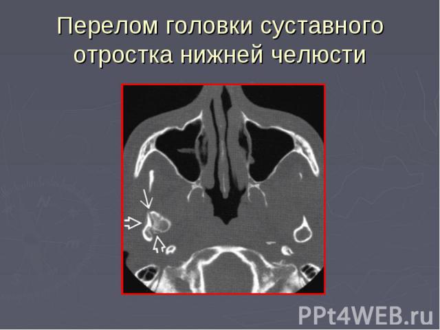 Перелом головки суставного отростка нижней челюсти