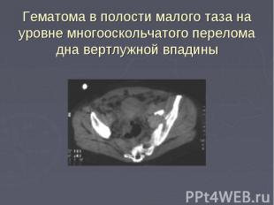 Гематома в полости малого таза на уровне многооскольчатого перелома дна вертлужн