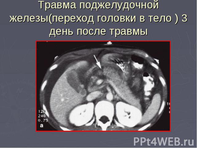 Травма поджелудочной железы(переход головки в тело ) 3 день после травмы