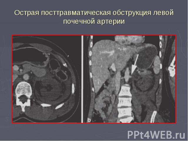 Острая посттравматическая обструкция левой почечной артерии
