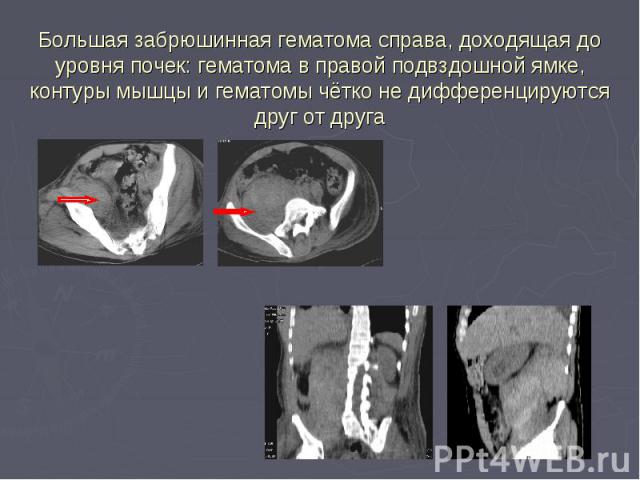 Большая забрюшинная гематома справа, доходящая до уровня почек: гематома в правой подвздошной ямке, контуры мышцы и гематомы чётко не дифференцируются друг от друга