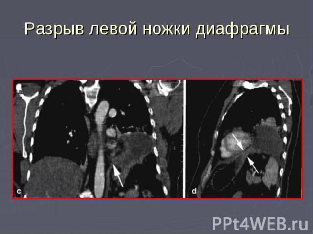 Разрыв левой ножки диафрагмы