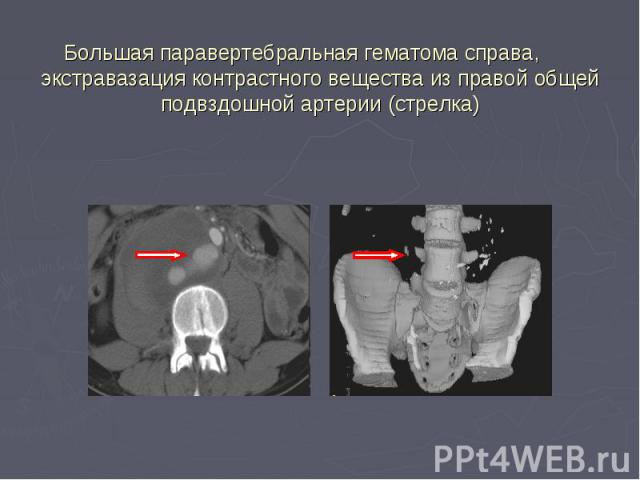 Большая паравертебральная гематома справа, экстравазация контрастного вещества из правой общей подвздошной артерии (стрелка)