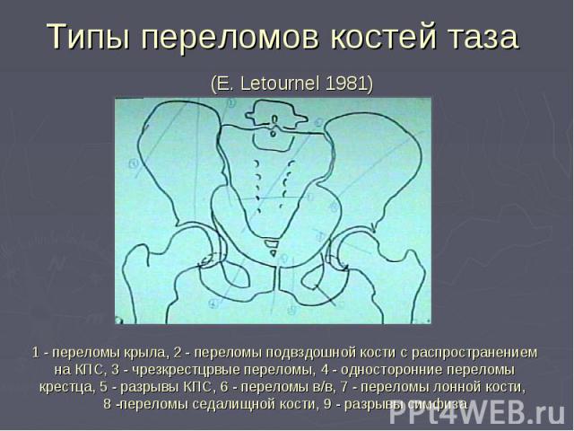 Типы переломов костей таза (E. Letournel 1981)