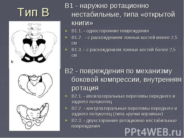 Тип В В1 - наружно ротационно нестабильные, типа «открытой книги» В1.1. - односторонние повреждения В1.2. - с расхождением лонных костей менее 2,5 см В1.3. - с расхождением лонных костей более 2,5 см В2 - повреждения по механизму боковой компрессии,…