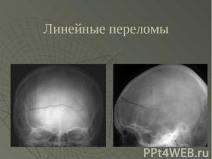 Классификация ушибов головного мозга корниенко