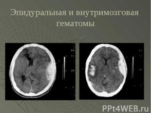 Классификация ушибов головного мозга корниенко