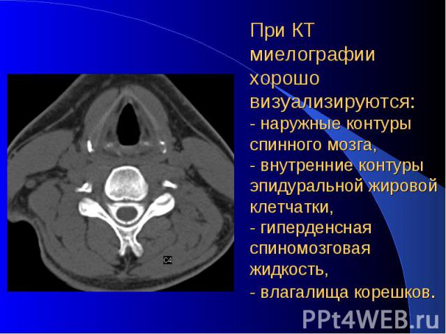 При КТ миелографии хорошо визуализируются: - наружные контуры спинного мозга, - внутренние контуры эпидуральной жировой клетчатки, - гиперденсная спиномозговая жидкость, - влагалища корешков.