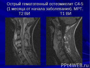 Острый гематогенный остеомиелит С4-5 (1 месяца от начала заболевания). МРТ. Т2 В