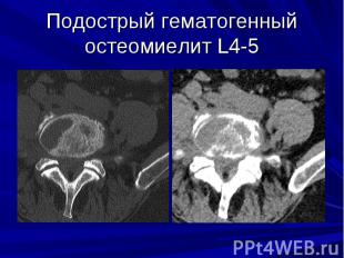 Подострый гематогенный остеомиелит L4-5