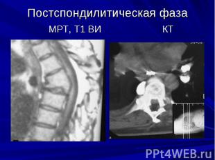 Постспондилитическая фаза МРТ, Т1 ВИ КТ
